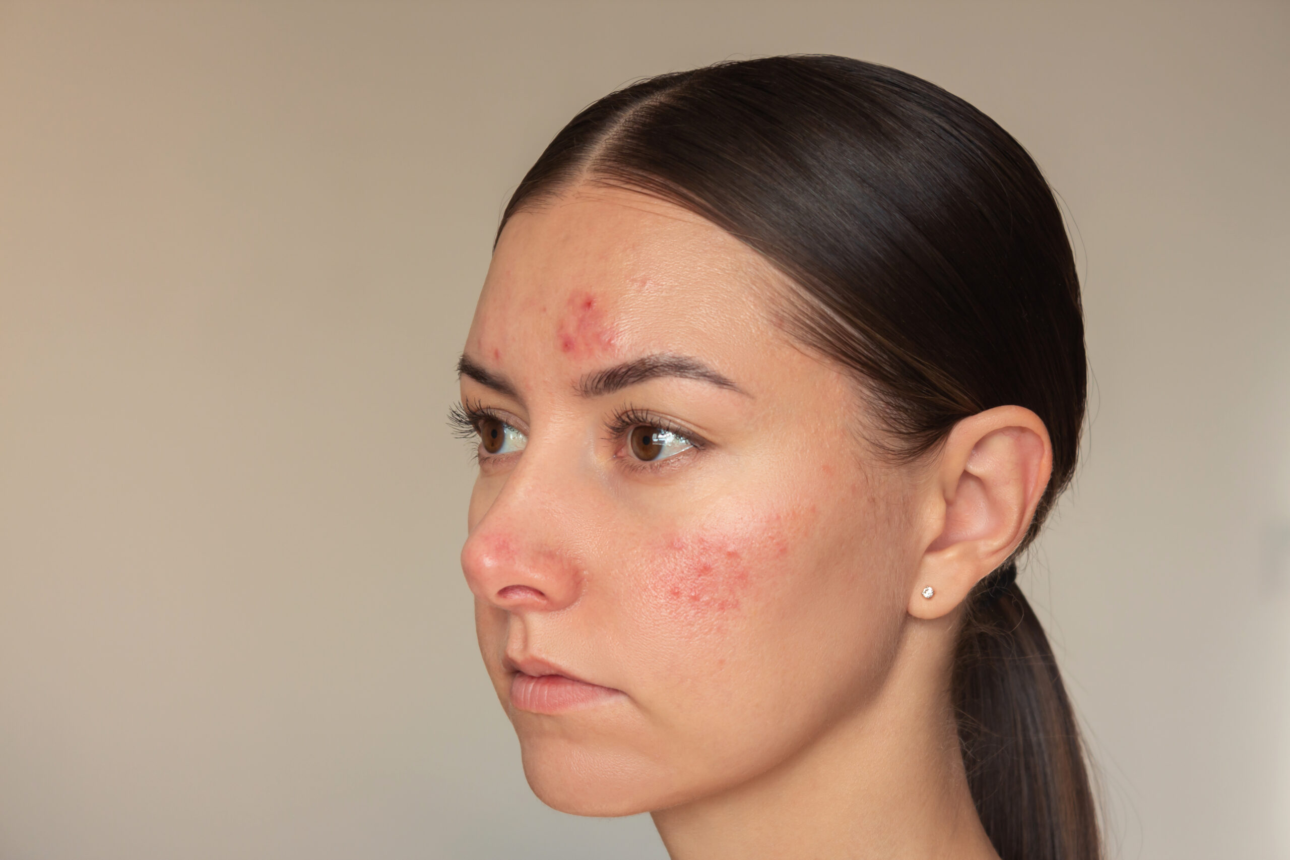 Acne