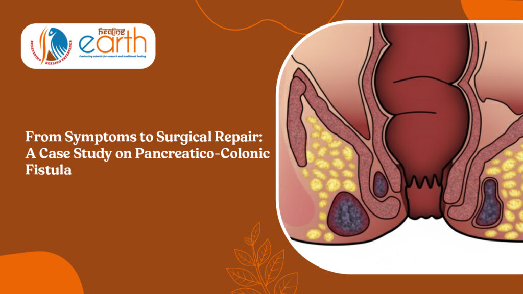 From Symptoms to Surgical Repair: A Case Study on Pancreatico-Colonic Fistula