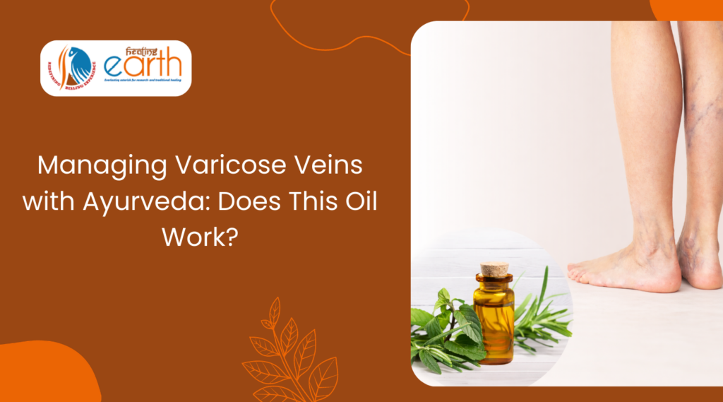 Managing Varicose Veins with Ayurveda: Does This Oil Work?